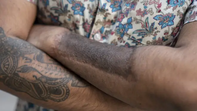 Harka mirgaa Aniik kan qaama saalaa isaa tolchuuf murame