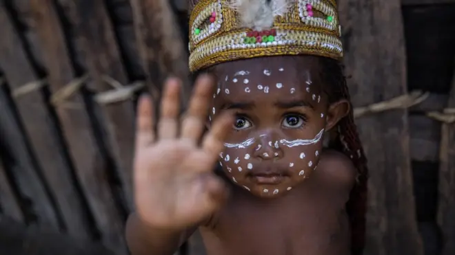 Wabah campak dan gizi buruk kembali mengancam anak-anak di Papua, 61 anak dilaporkan meninggal dunia