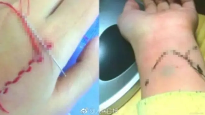 People's Daily memperingatkan orangtua untuk mewaspadai usaha menyakiti diri ini.