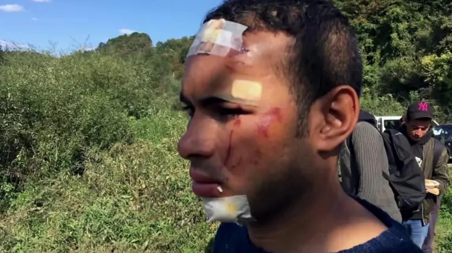 Један од миграната у Босни са видним повредама главе