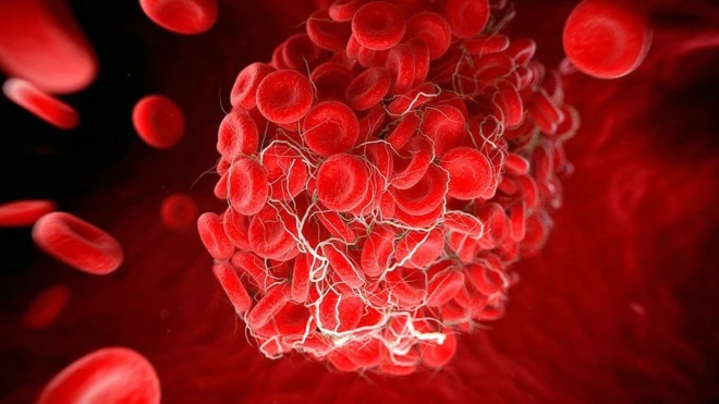 ภาพขยายของเม็ดเลือดที่เกาะตัวกันขณะที่เกิดลิ่มเลือด