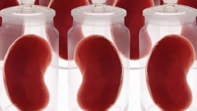 Azərbaycanda 200-ə yaxın insan böyrək transplantasiyası üçün növbə gözləyir