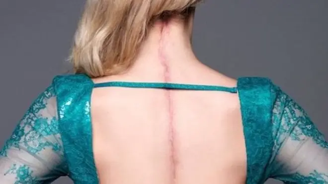 La espalda de Victoria con una cicatriz