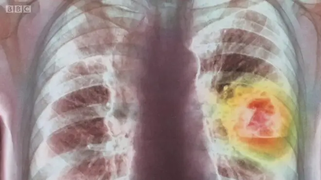 Escáner de pulmones