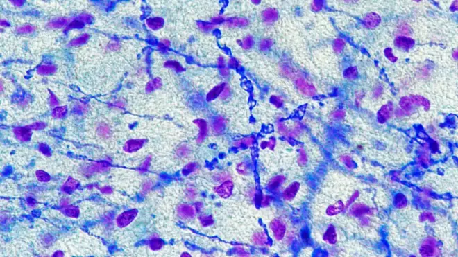 تاثیر بیماری ام اس بر ساخت عصبی