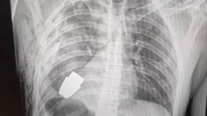 الأشعة تبين العبوة قرب قلب الجندي.