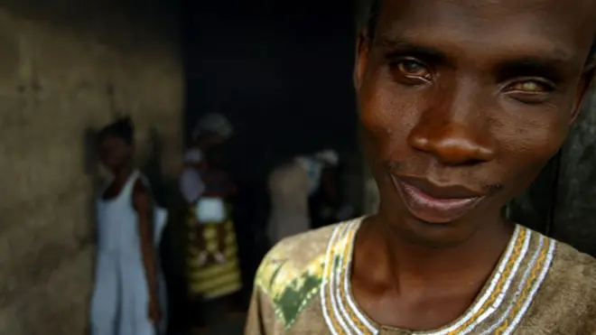 River blindness be one of di Neglected tropical disease (NTD) Wwey dey affect people for di world