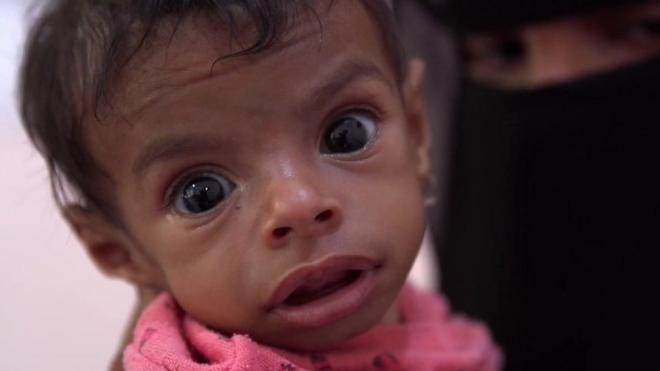 飽受戰火牽連的也門小孩