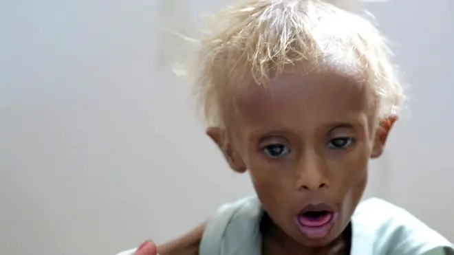 Kondisi Saleem tahun lalu, usia delapan tahun dan sangat ringkih.