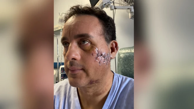 Mauricio muestra la herida que le dejó el tiburón en el rostro.