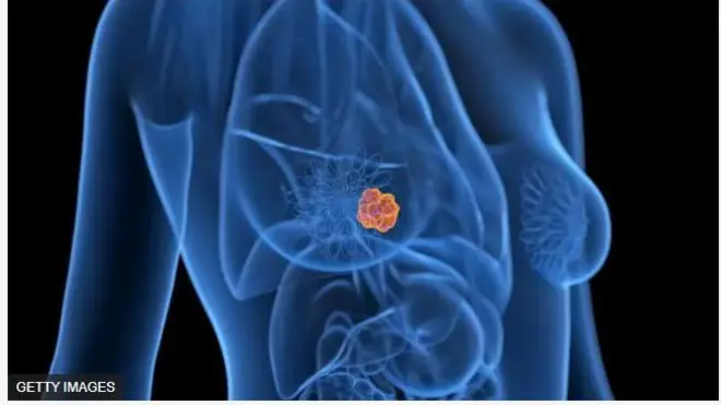 Aworan ọmu to ni apẹẹrẹ jẹjẹrẹ.