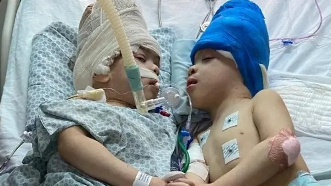 Sijamski blizanci Brazil