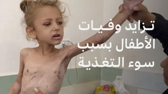 استحدثت مستشفى الرنتيسي في قطاع غزة قسما لعلاج سوء التغذية بين أطفال قطاع غزة مع تفاقم أزمة نقص الطعام.