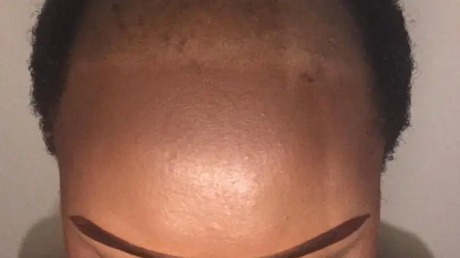 Bandile say if to say she march break, she for fit prevent her baldness