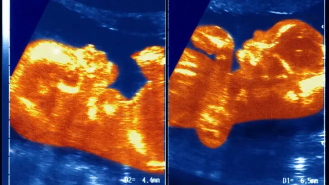 Um ultrassom de bebê gêmeos.