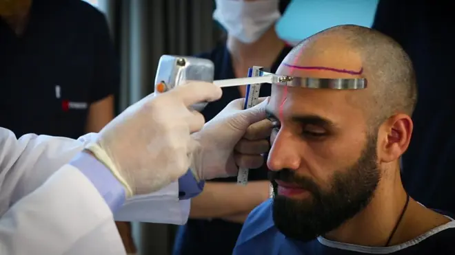 كلفة زراعة الشعر
