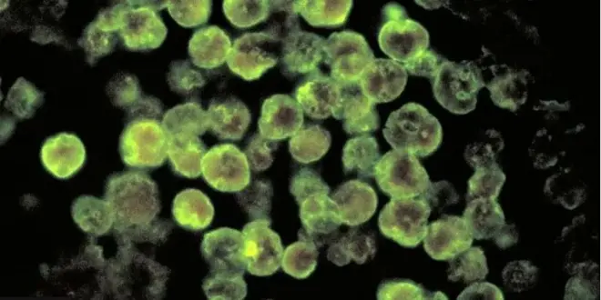 Aworan Aarun to jẹ ọpọlọ