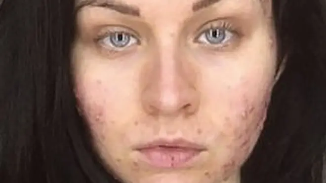 La sequedad extrema de los labios es uno de los efectos secundarios habituales del tratamiento con isotretinoína.