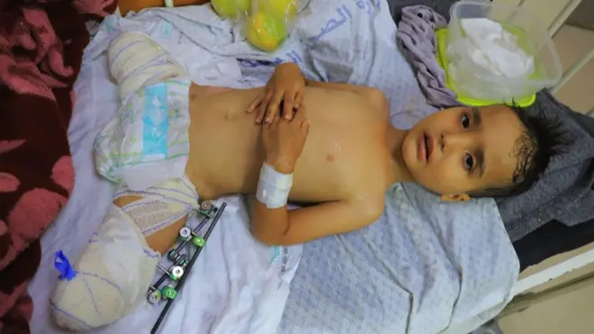 Three-year-old Ahmed Shabat in hospital