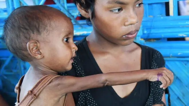 Seorang balita diantarkan oleh kakaknya ke dokter untuk mendapatkan perawatan akibat malnutrisi.