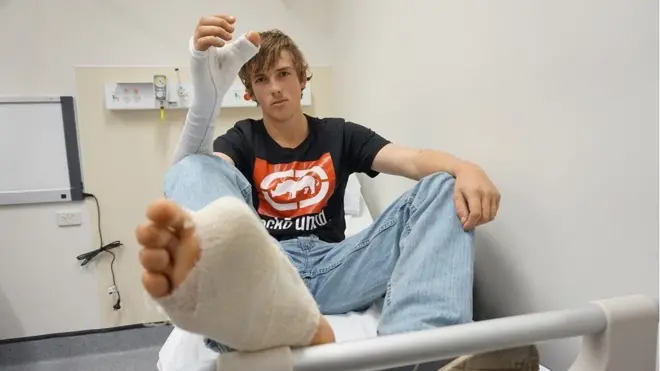 20-річний австралієць пошкодив руку під час нападу бика й погодився на трансплантацію