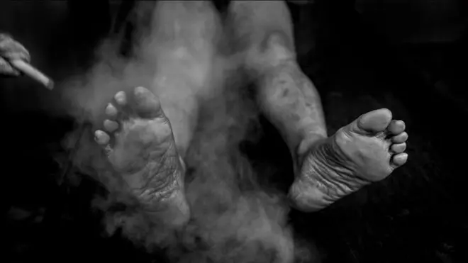 ભોપાલની સંભાવના ટ્રસ્ટ ક્લિનિકમાં એક પીડિતની સ્ટીમ થૅરપીથી સારવાર થઈ રહી છે. આ ક્લિનિકમાં પારંપરિક આયુર્વેદિક દવાથી પીડિતોનો ઇલાજ થાય છે.