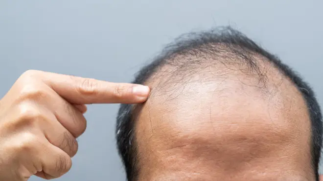 केस गळती थांबवता येते का? डॉक्टर काय सल्ला देतात