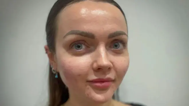  چہرے کی خوبصورتی کے لیے انجیکشن 