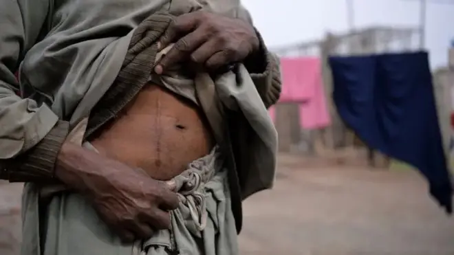 گردوں کا غیر قانونی ٹرانسپلانٹ