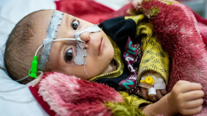 پسری افغان به نام سراج، هشت ماهه و دچار سوءتغذیه شدید، در میان کودکانی است که بخش‌های تغذیه درمانی شفاخانه دولتی «اندراگاندی» برای سلامت کودکان در کابل، افغانستان، را پر کرده‌اند.
