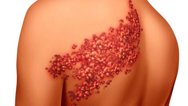 Ilustraçãoslot santa surpriseherpes-zóster