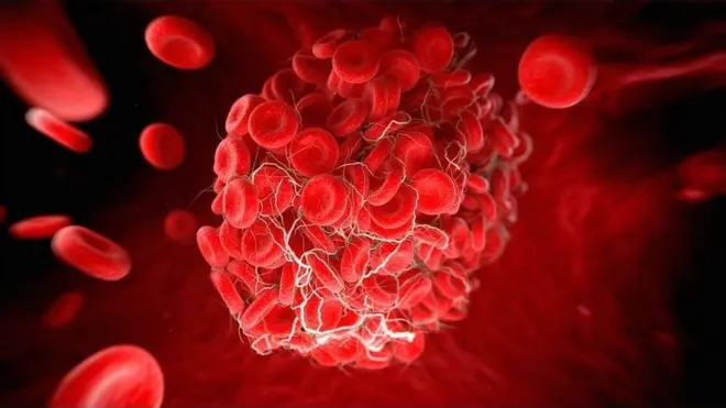 ภาพขยายของเม็ดเลือดที่เกาะตัวกันขณะที่เกิดลิ่มเลือด