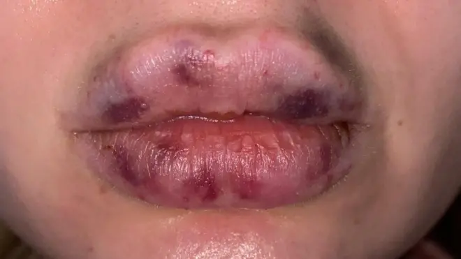 Angel, who found someone on Instagram to give her lip fillers in lockdown, says there was a lot of "pain and blood" during the procedure