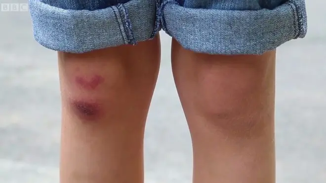 Синці не потребують окремого лікування, але прикладання холодного полегшує біль