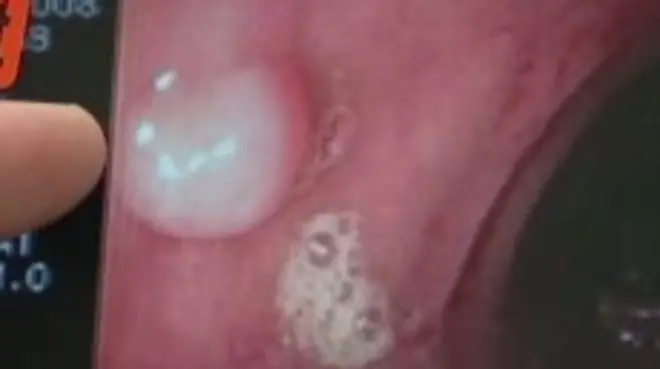 فحص مبكر للأمعاء يقلل من خطر الإصابة بالسرطان إلى الثلث