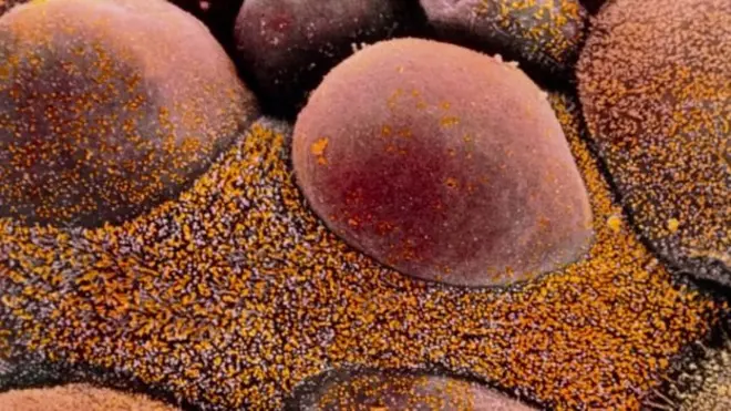 يصعب أحيانا علاج سرطان المبيض