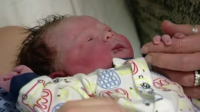 الولادة القيصرية قد تؤثرعلى تطور البشر