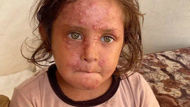 تعاني سميرة وإخوتها الأربعة من طفح جلدي حاد يزداد سوءا بسبب قسوة حياة المخيمات 