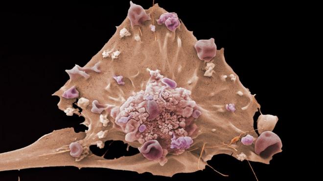Célula de cáncer de mama