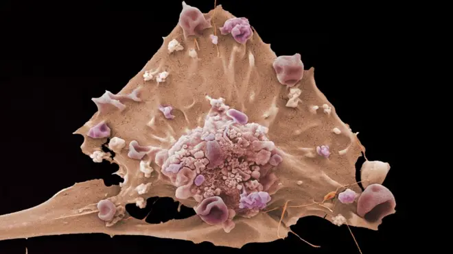 Breast cancer cell