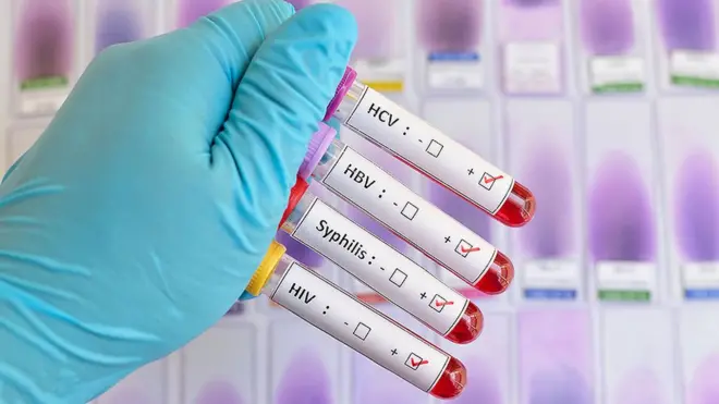 ኮሮናቫይረስ፡ ብጾታዊ ርክብ ዝመሓላለፉ ሕማምት ንምቁጽጻር ዝፈጠሮ ተስፋ