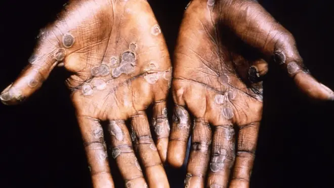 Picture of pesin wey get monkeypox