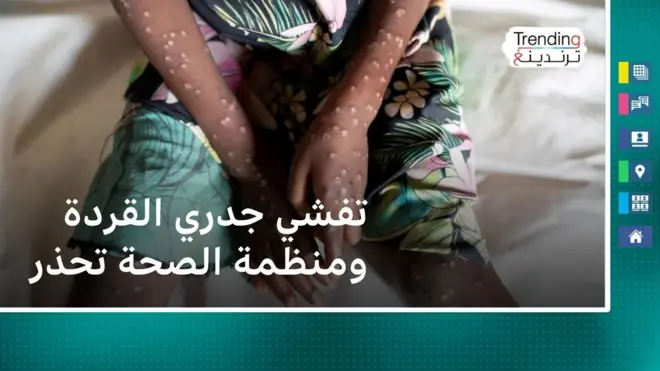 جدري القردة