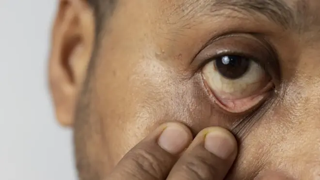 పచ్చకామెర్లు