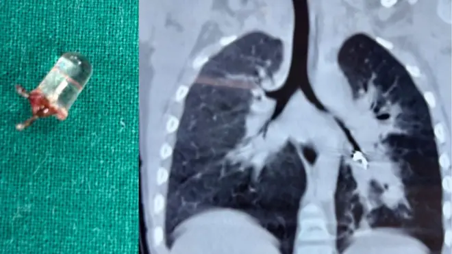 3 वर्षाच्या मुलाच्या फुप्फुसातून काढला LED बल्ब; मुलांनी नाणी, बॅटरी, चुंबक गिळल्यास काय करायचं? वाचा
#बालआरोग्य #BBCमराठी #LEDबल्ब #ChildSafety #HealthAwareness #पॅरेंटिंग #EmergencyCare