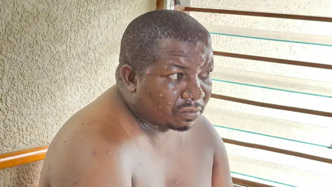 Egide Irambona mu kigo kivura abagwayi ba Mpx mu bitaro Roi Khaled, 22 Myamdagaro 2024