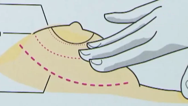 स्तन कैंसर