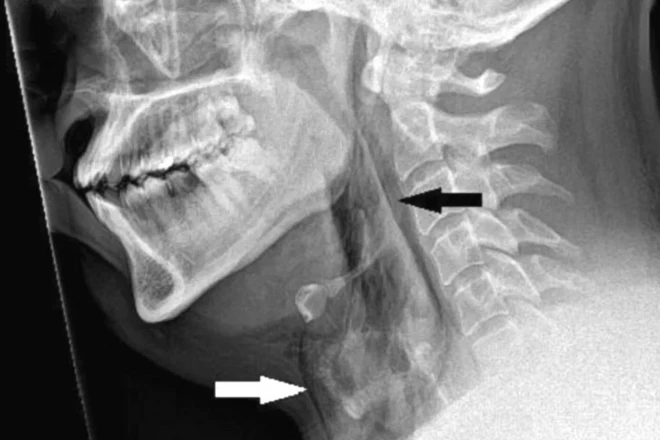 yırtığın röntgeni