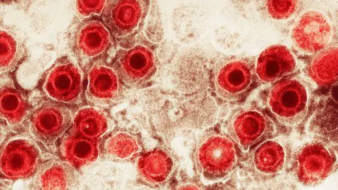 Vírus herpes simplex