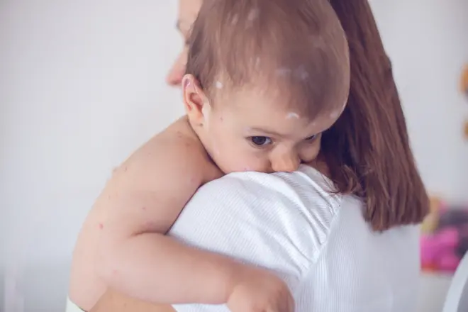 गोवरची लागण झालेलं एक बाळ